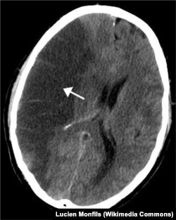 Изображение поврежденного участка мозга, полученное методом компьютерной томографии